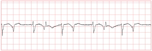 ECG waveform